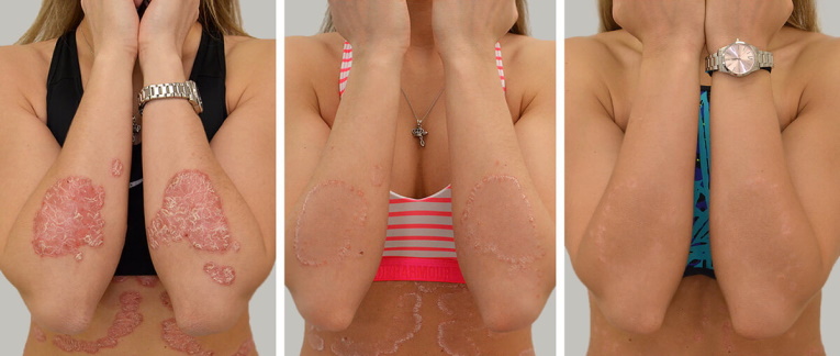 krém pikkelysömör ekcéma dermatitis kezelésére hogyan kell kezelni a guttate pikkelysömörét